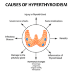 hyperthyroidism causes