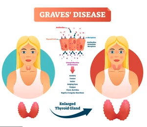 Thyroid symptoms in graves disease