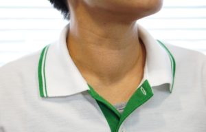 Thyroid symptoms - swelling of the neck