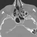 CT findings of Deviated Nasal Septum with Concha Bullosa. Image courtesy of Assoc Prof Frank Gaillard, Radiopaedia.org. From the case rID: 9762