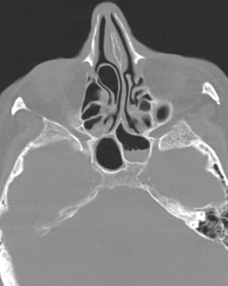 CT findings of Deviated Nasal Septum with Concha Bullosa. Image courtesy of Assoc Prof Frank Gaillard, Radiopaedia.org. From the case rID: 9762