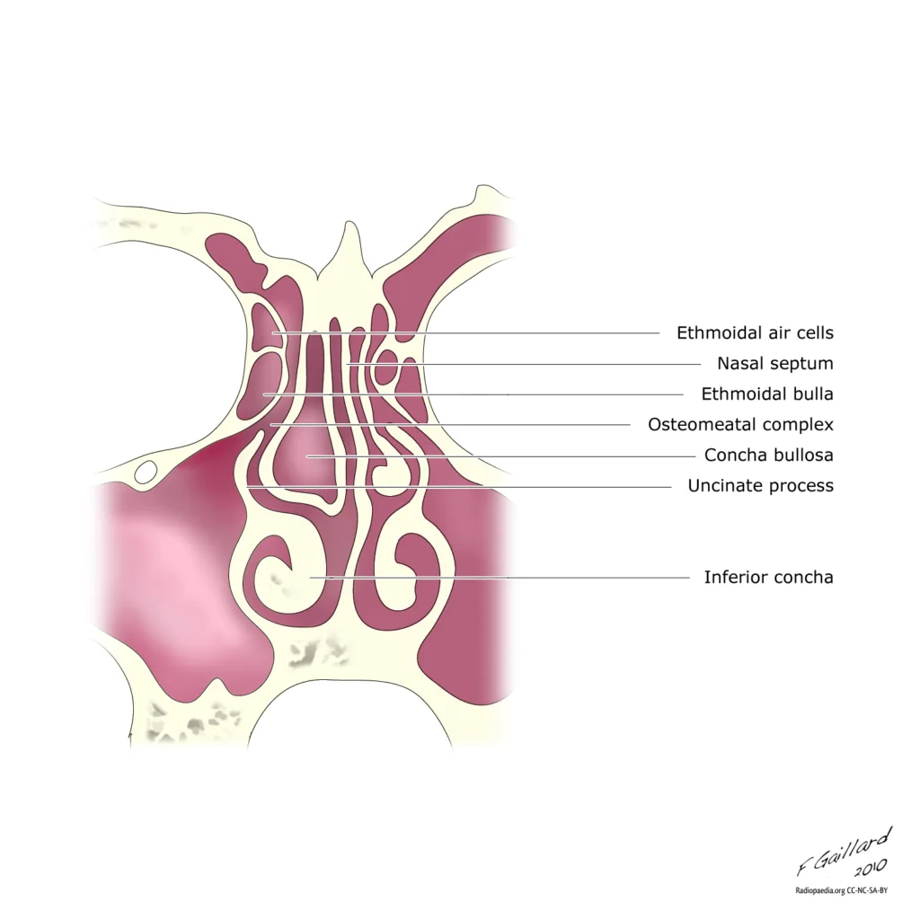 Diagram of concha bullosa